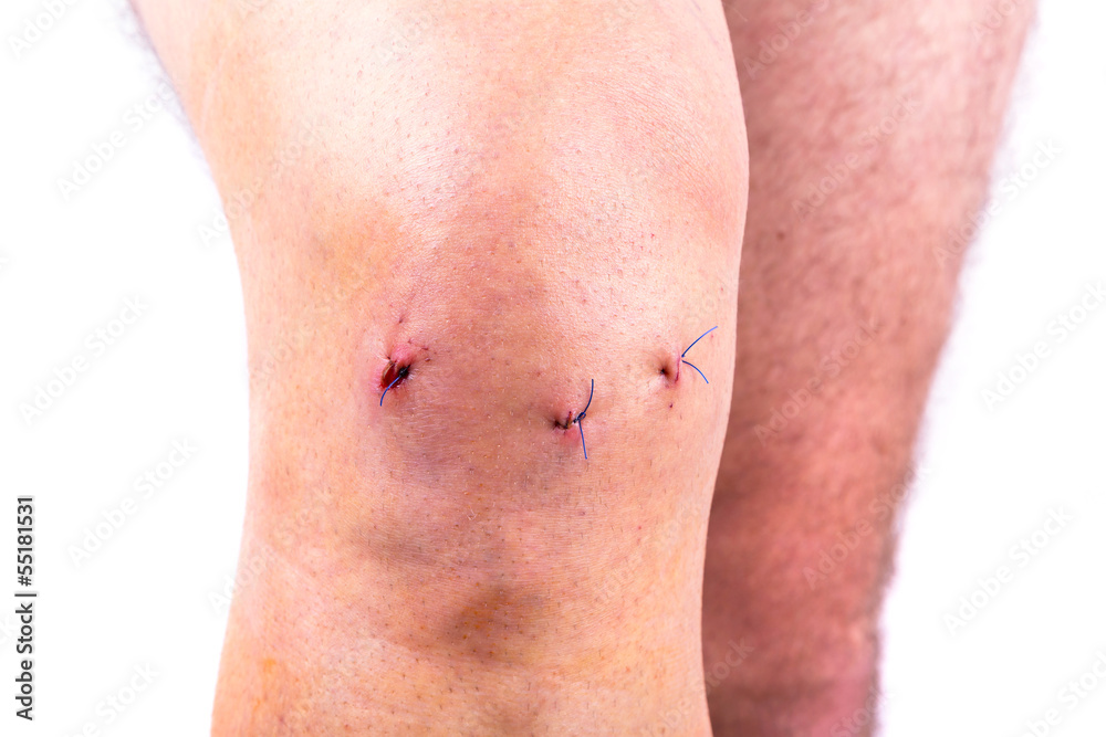 Man knee after arthroscopic surgery with stitches Man knee after arthroscopic surgery with stitches