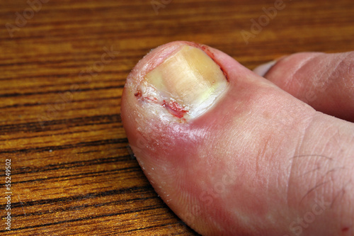 Infection in the nail toe