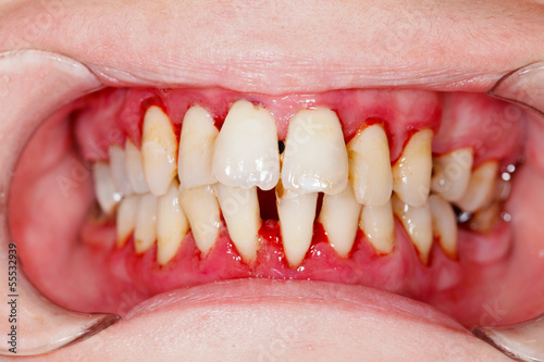 Fototapeta Naklejka Na Ścianę i Meble -  After Dental Treatment