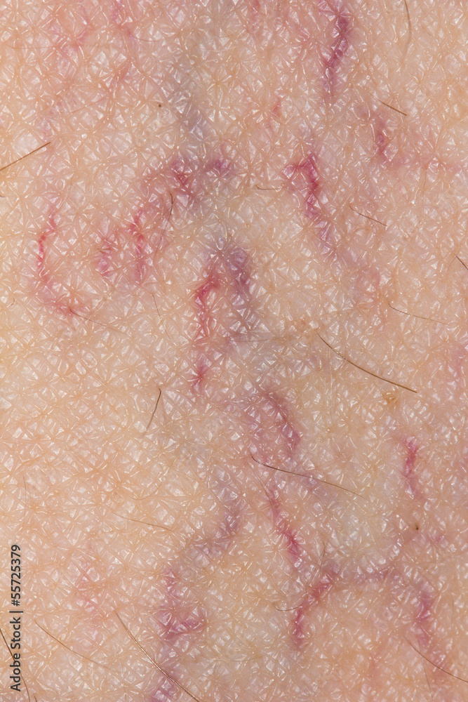 Fototapeta premium varicose veins on the skin. Macro