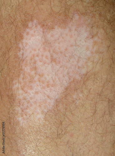 Vitiligo Spot on the Leg