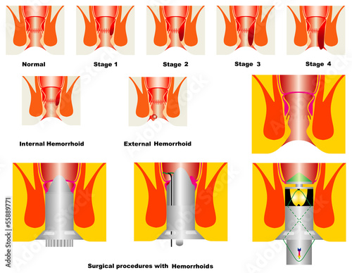 Hemorrhoids stage