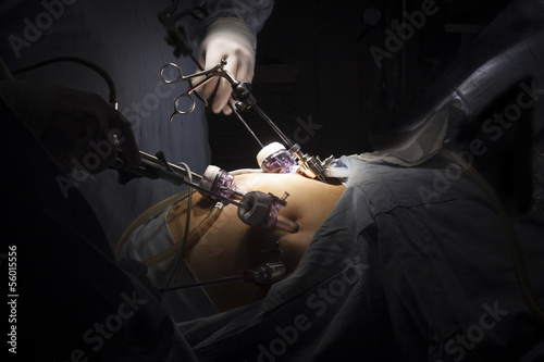Gastric bypass surgery