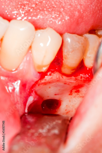 Surgical intervention