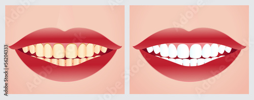 Teeth whitening before and after the treatment.
