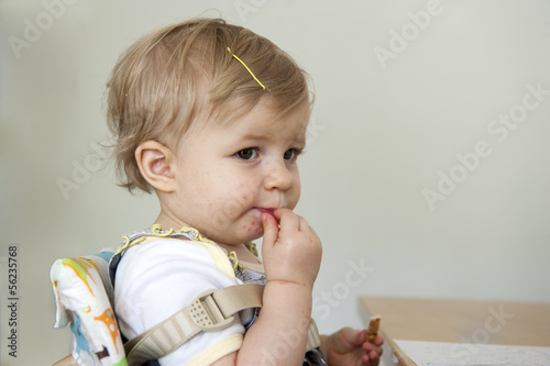 Toddler with hand , foot and mouth disease photo