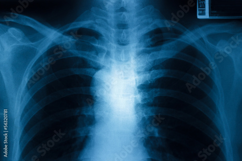 Chest x-ray