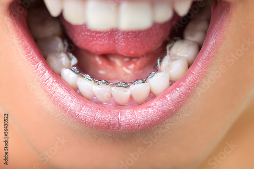 Close up of lingual braces