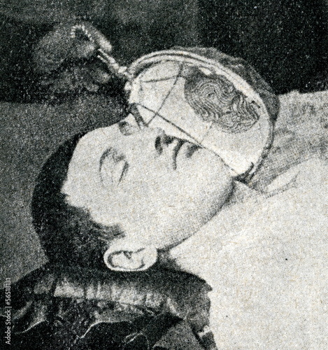 Obraz na plátně Preparing to inhal ether as a surgical anesthetic ca. 1920