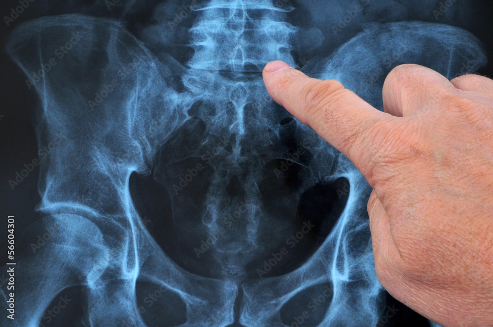 Radiographie Du Rachis Dorso lombaire Stock Photo Adobe Stock