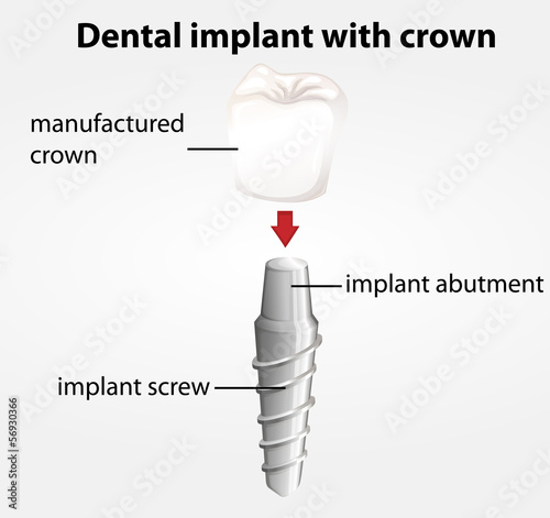 Dental implant with crown