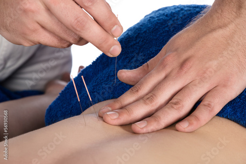 Physiotherapist doing accupuncture