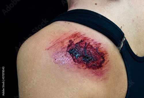 open wound on woman shoulder