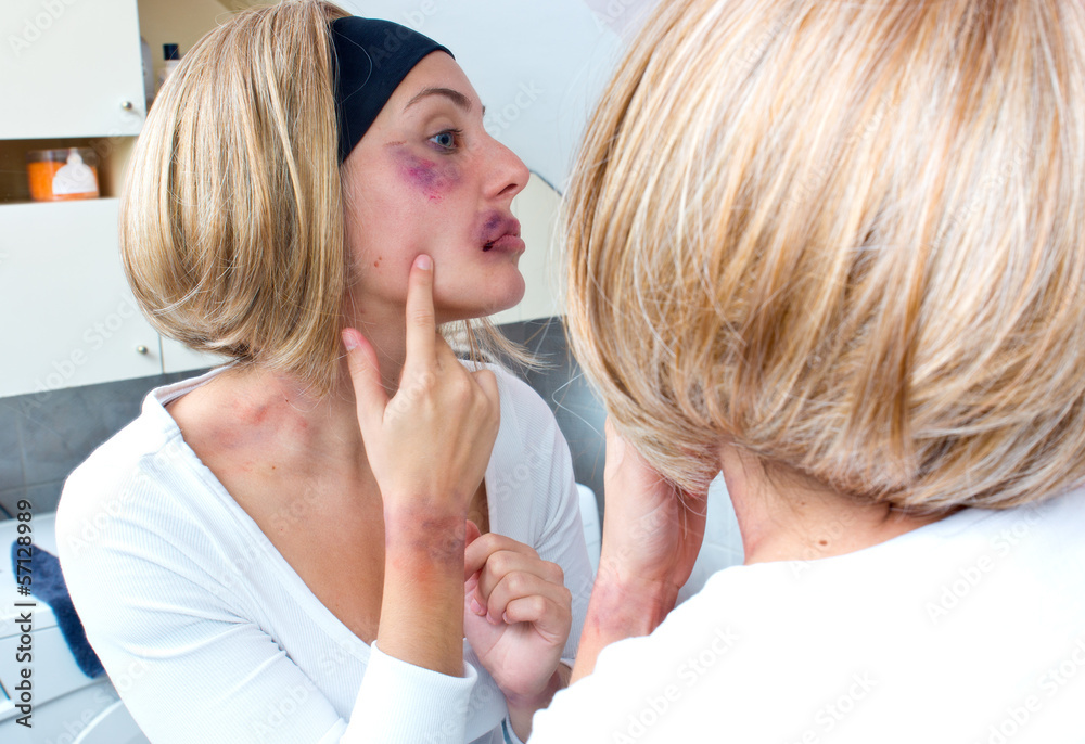 woman covered with bruises in front of the mirror