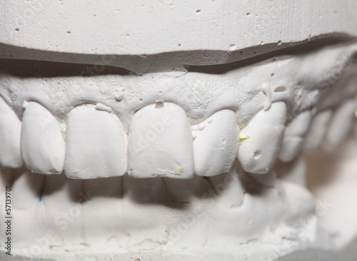 Dental gypsum model mould of teeth in plaster photo