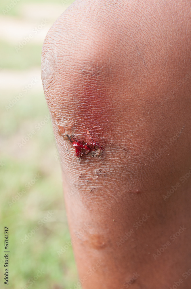 Fototapeta premium The wound on his leg