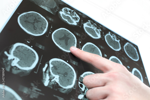 CT scan of the patient's brain and the hand of a doctor. photo