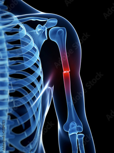 medical illustration of a borken arm bone