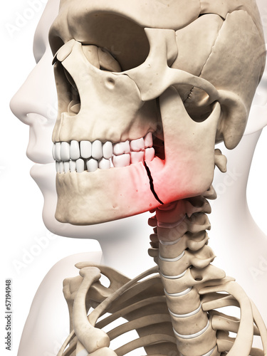 Fotografie medical illustration of a broken jaw bone