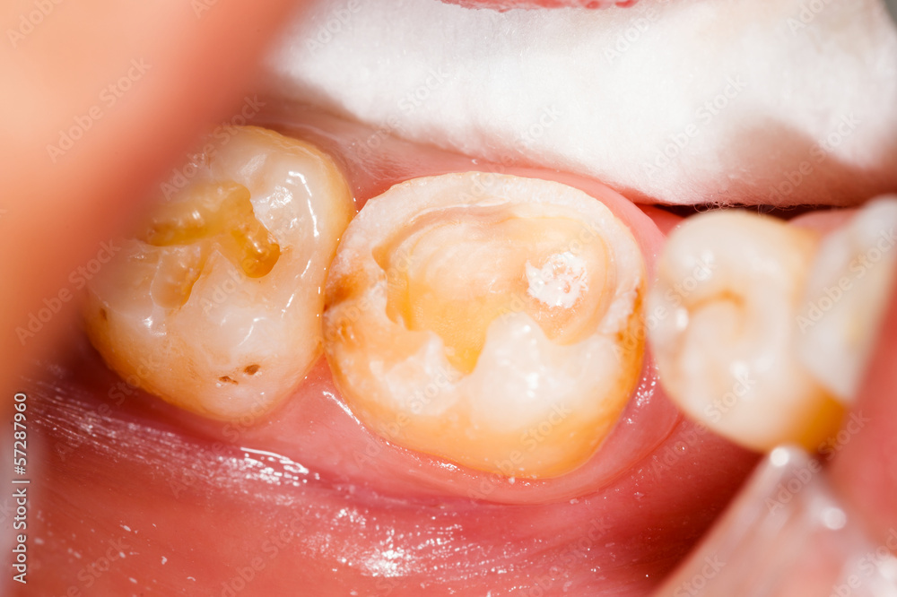 Fototapeta premium Before Treatment