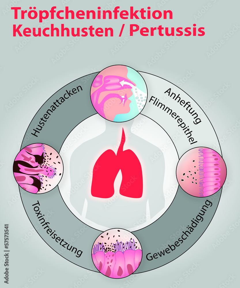 Was Sind Die 3 Stadien Von Keuchhusten Keuchhusten_Pertussis_Infektion Stock-Vektorgrafik | Adobe Stock