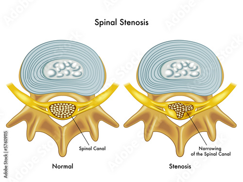 stenosi spinale photo