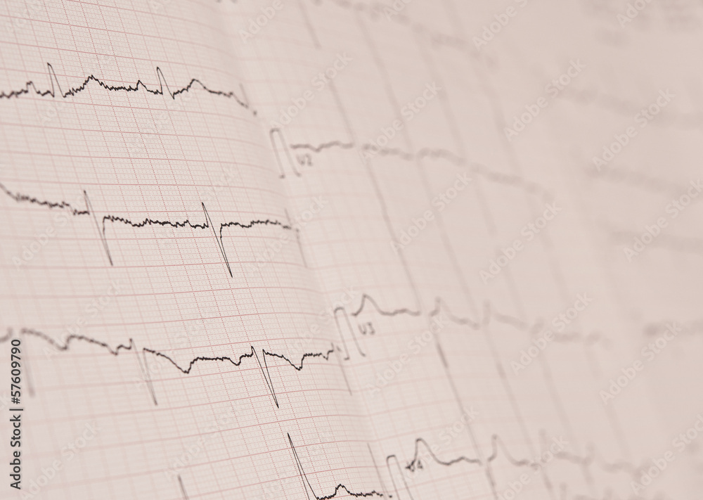 Detail of an electrocardiogram in paper Detail of an electrocardiogram in paper