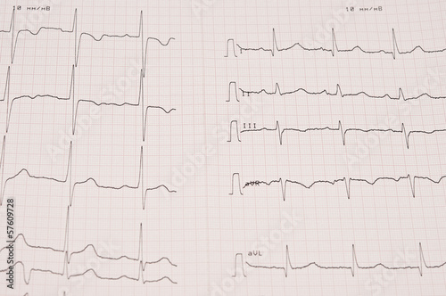 Quadro su tela cardiogram