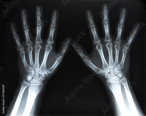 X-Ray image of human hands