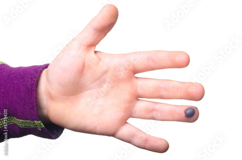 Blood blister