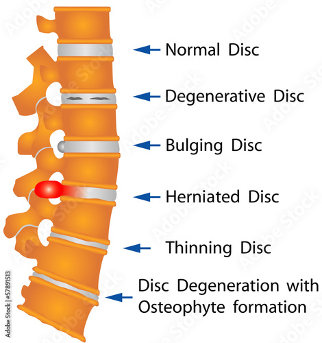 Spine. Spine conditions