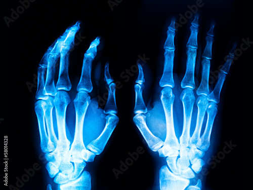 X-Ray Hands photo