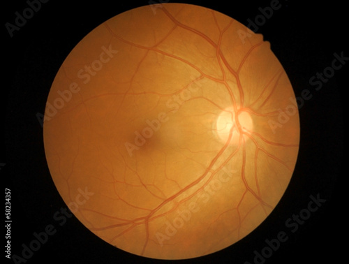 Medical photo retina and optic nerve photo