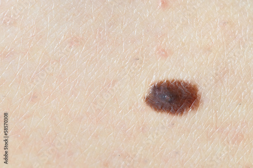 Brown birthmark (nevus) on Caucasian woman leg. photo