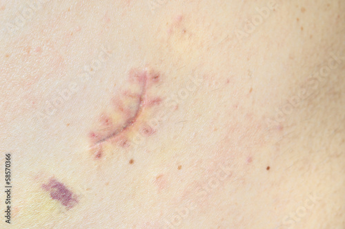 Close-up of a fresh scar on a male back.