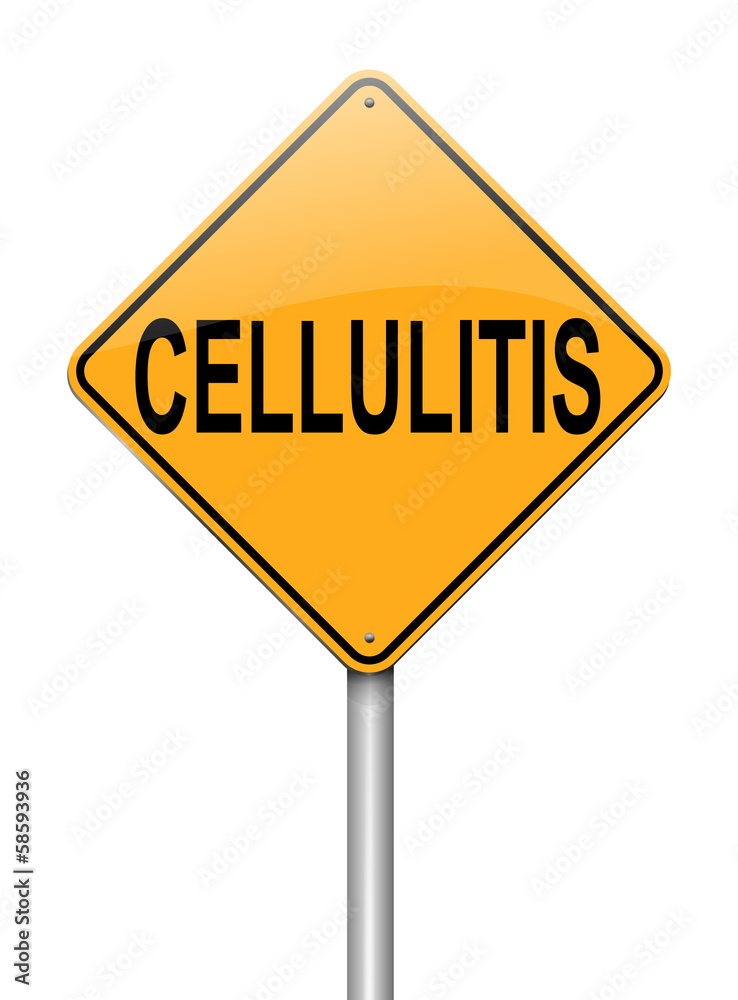 Cellulitis concept. Cellulitis concept.