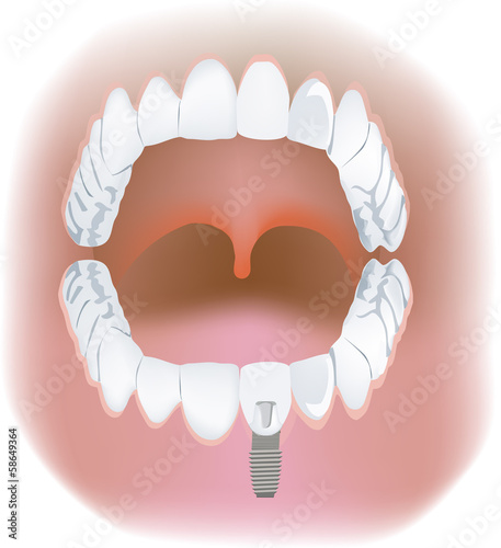 impianto dentale
