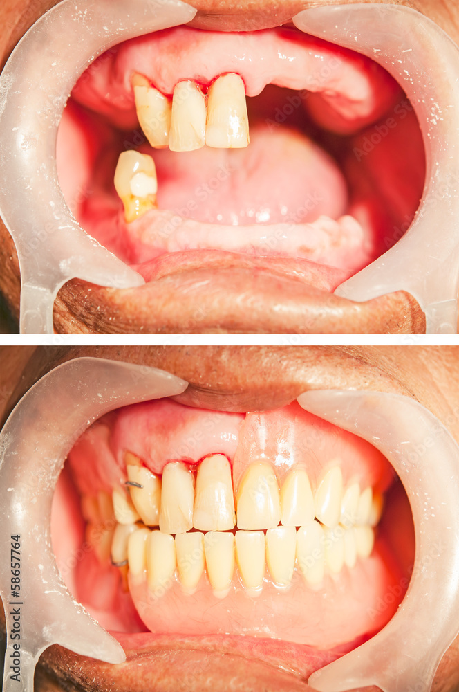 Dental rehabilitation with upper and lower prosthesis, before an
