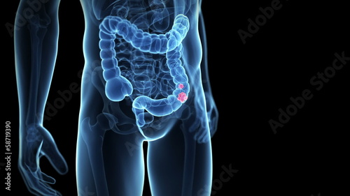 colon cancer
