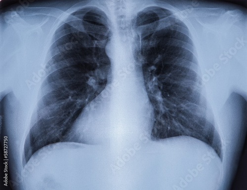 chest X-ray