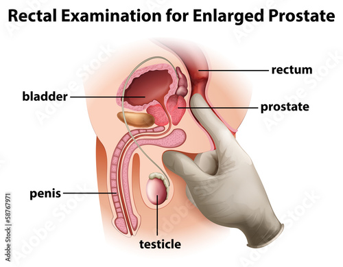 Fotobehang Rectal Examination for Enlarged Prostate
