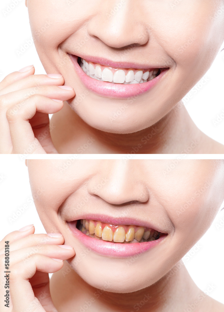 woman teeth before and after whitening woman teeth before and after whitening