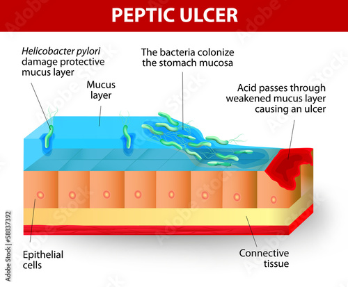 Helicobacter pylori and ulcers disease