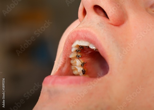 Lingual braces