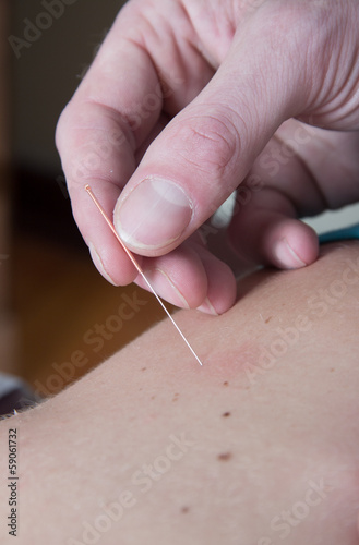 Chiropractor acupuncture needle of female patient