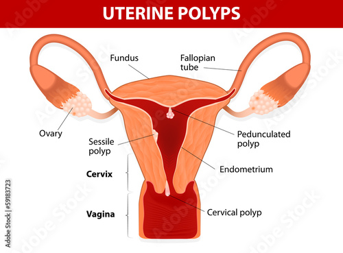 Endometrial polyp or uterine polyp