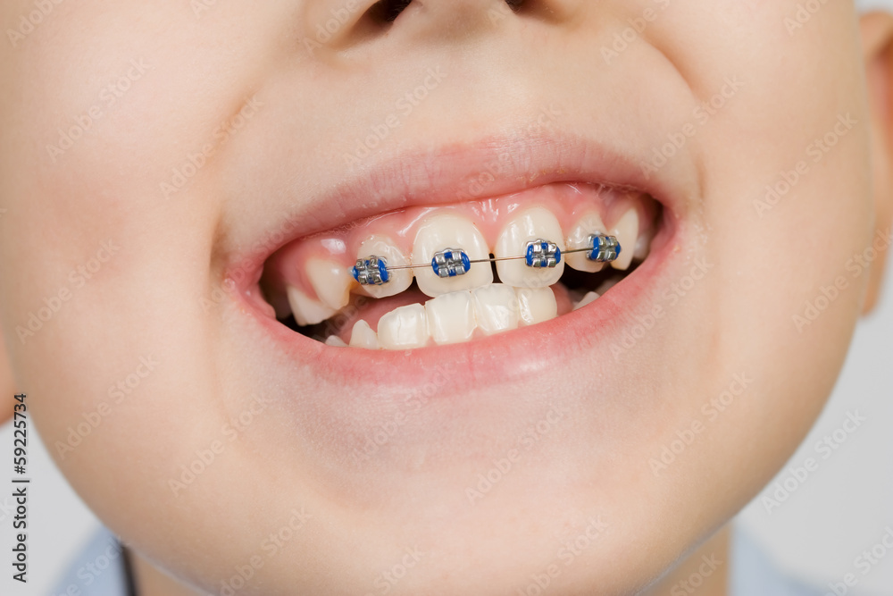 Naklejka premium braces