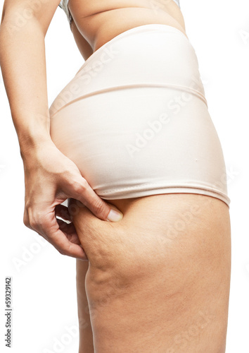 Women's cellulite onleg