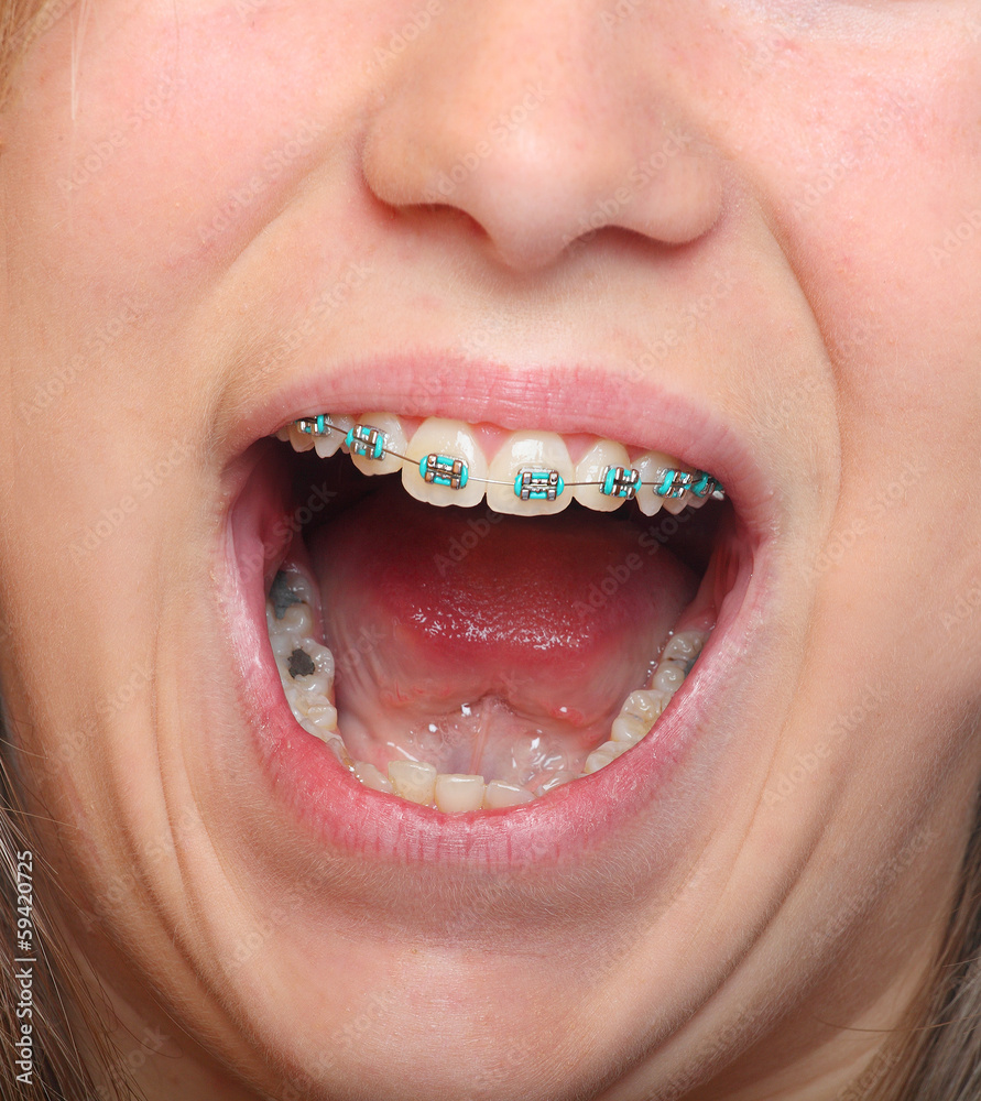 Rotten Teeth From Braces