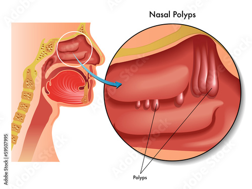 polipi nasali